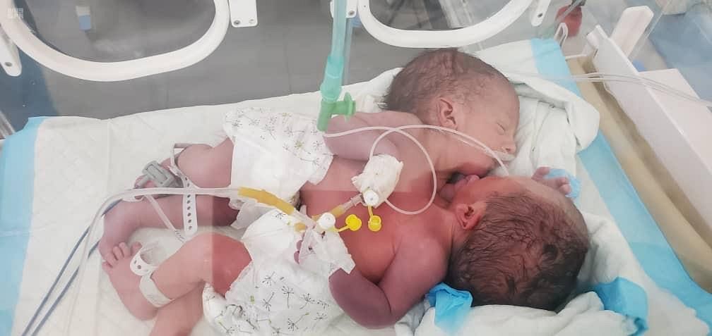 Newly born conjoined twins lie in an incubator at the child intensive care unit of Al-Sabeen hospital in Sanaa, Yemen Dec. 18, 2020. (SPA)