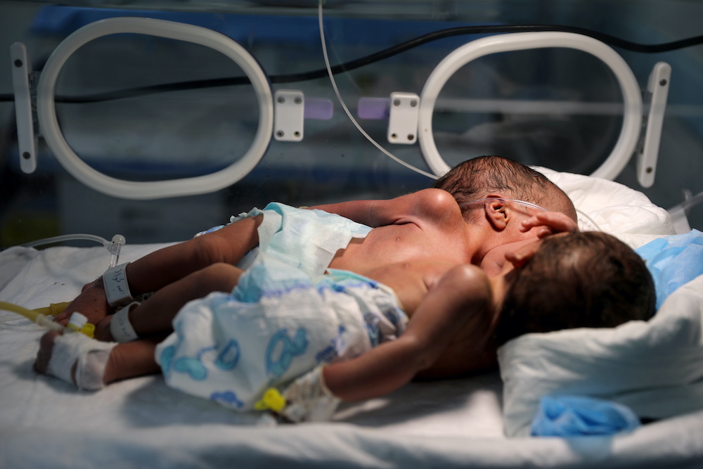 Newly born conjoined twins lie in an incubator at the child intensive care unit of Al-Sabeen hospital in Sanaa, Yemen Dec. 18, 2020. (Reuters)