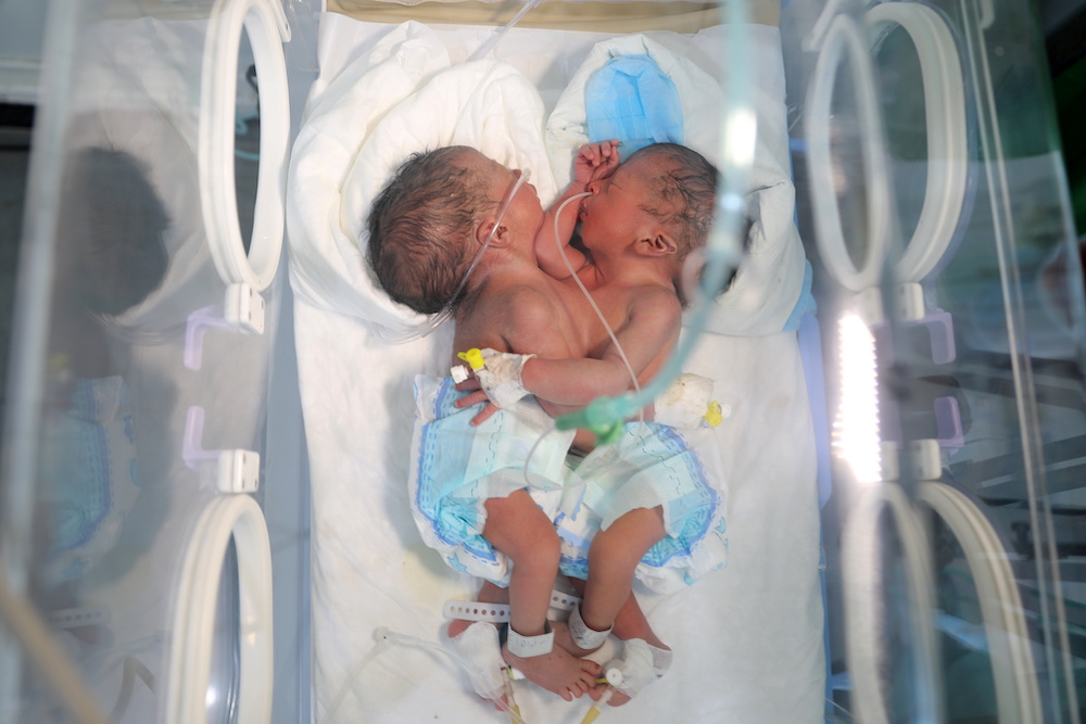 Newly born conjoined twins lie in an incubator at the child intensive care unit of Al-Sabeen hospital in Sanaa, Yemen Dec. 18, 2020. (Reuters)