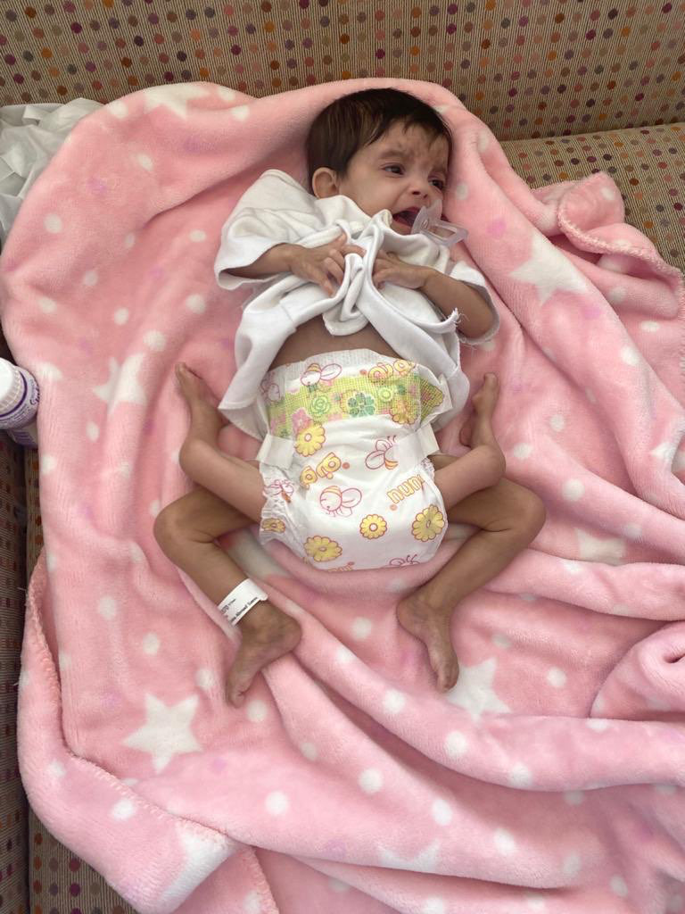 Operation To Separate Yemeni Child From Parasitic Twin In Saudi Arabia Declared A Success Arab News