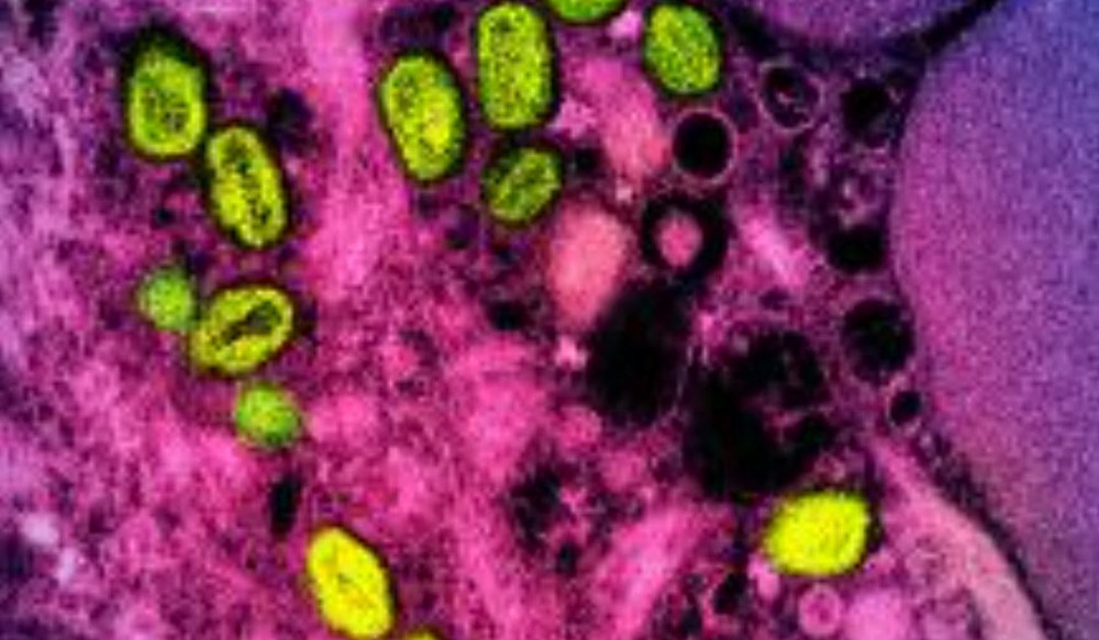 This undated image shows a colorized transmission electron micrograph of monkeypox particles (green) found within an infected cell (pink and purple), cultured in the laboratory. (AFP)