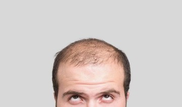 Short, white men more likely to go bald: study