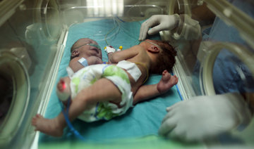 Palestinian conjoined twins arrive in Riyadh