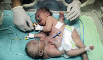 Palestinian conjoined twins separation surgery successful