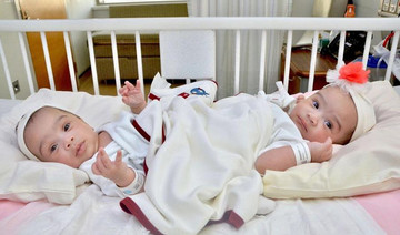 Saudi Siamese twins to be separated on Thursday