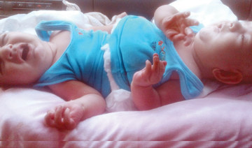 Libyan conjoined twins will come to Riyadh for treatment