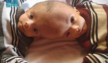 Yemeni conjoined twins to fly to Riyadh for medical examination