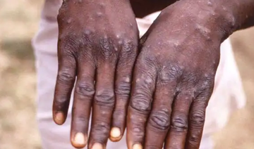 People vaccinated against smallpox likely safe from monkeypox, says specialist‏‏