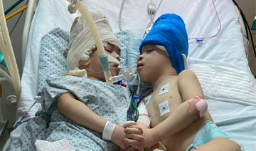 Conjoined twins separated with help of virtual reality in Brazil