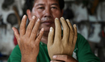 ’Constant danger’: Life after leprosy, a long neglected disease
