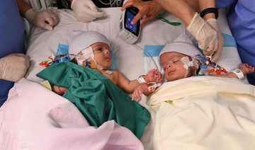 Surgeons in Riyadh successfully separate Yemeni conjoined twins
