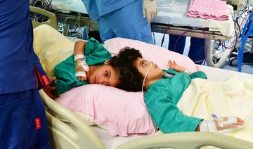 Saudi surgeons separate Egyptian conjoined twins