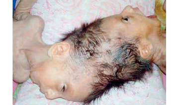 Operation ordered by king to separate Syrian Siamese twins