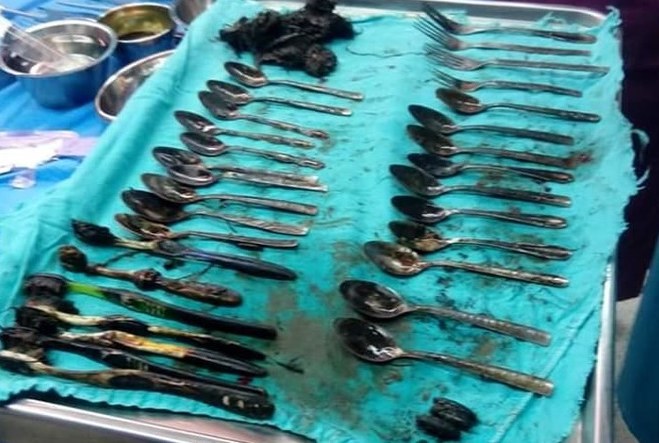 Egyptian surgeons recover 20 spoons from patient’s stomach