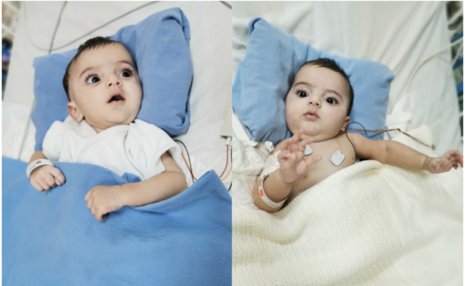 Top Saudi surgeon visits separated conjoined twins