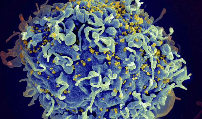 This electron microscope image made available by the National Institutes of Health shows a human T cell (blue) is under attack by HIV (yellow), the virus that causes AIDS. (AP)