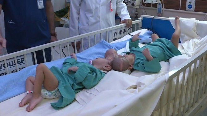 Saudi doctors separate conjoined twins from war-torn Yemen