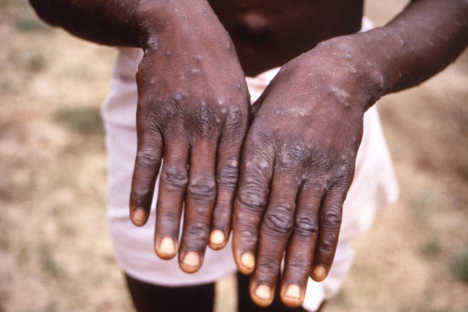 Monkeypox cases detected in Spain, Portugal and US