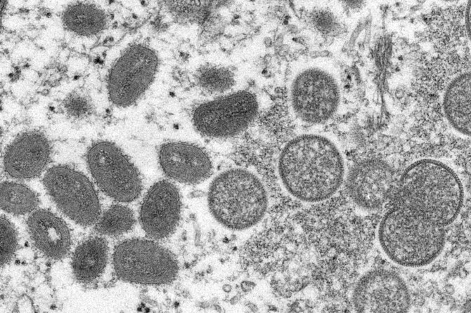 UAE announces first case of monkeypox 
