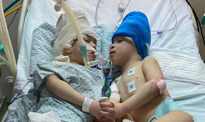 Conjoined twins separated with help of virtual reality in Brazil