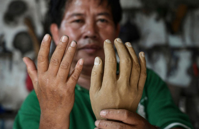 ’Constant danger’: Life after leprosy, a long neglected disease