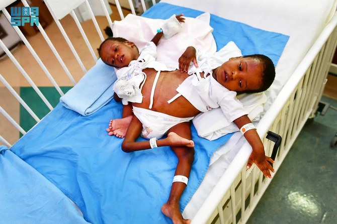 Saudi experts to separate conjoined Tanzanian twins
