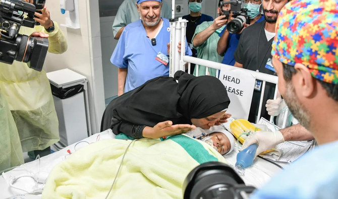 Saudi doctors perform 16-hour surgery to separate conjoined Tanzanian twins